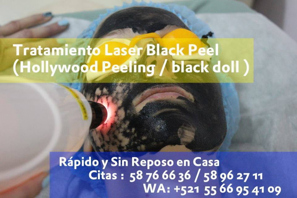 Tratamiento Laser Black Peel (Hollywood Peeling / black doll )